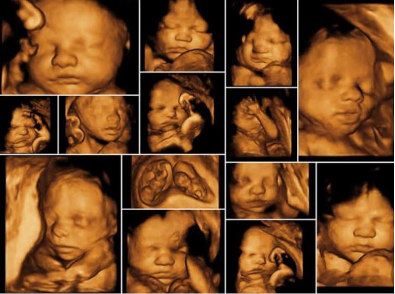 3D/4D ULTRA SONOGRAPHY