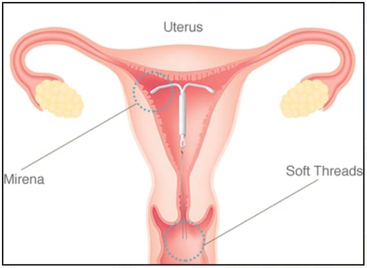 MIRENA INSERTION