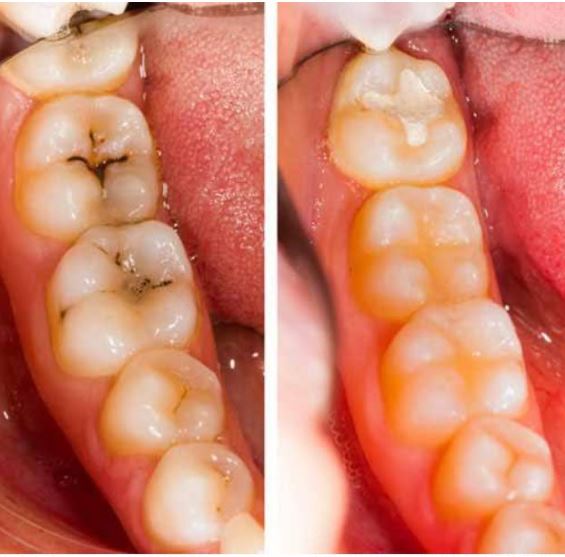 TOOTH COLOURED FILLINGS