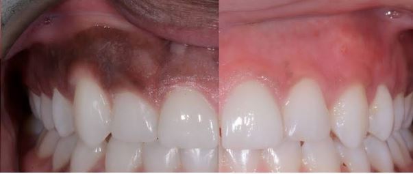 GUM DEPIGMENTATION