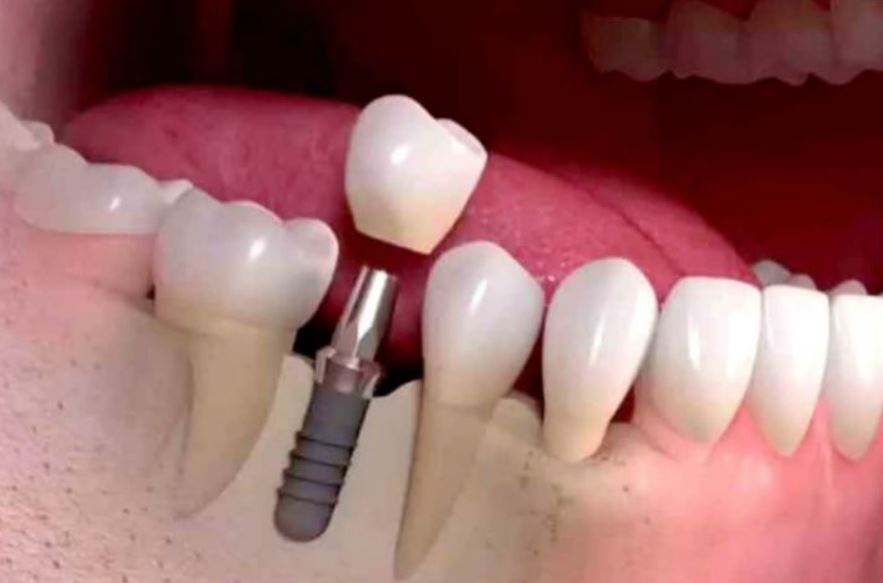 IMPLANTOLOGY