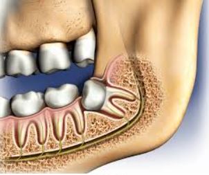 WISDOM TOOTH REMOVAL