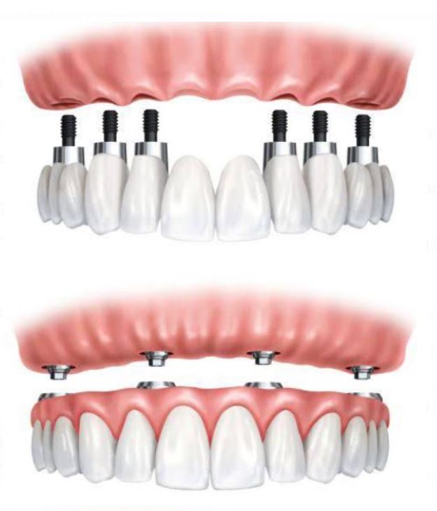 FULL MOUTH REHABILITATION