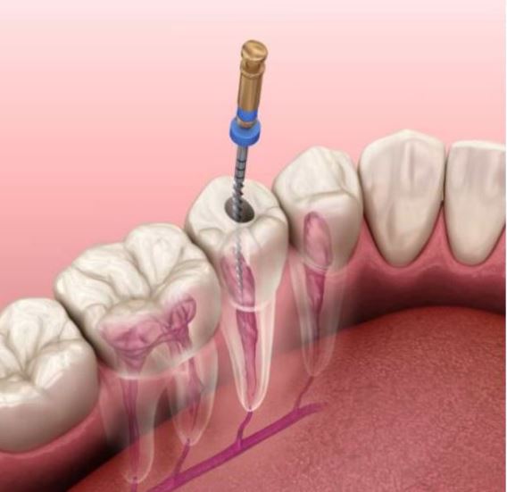 ROOT CANAL TREATMENT