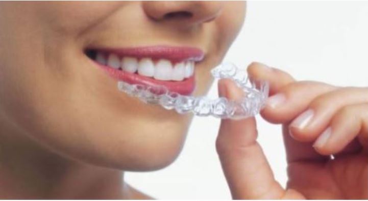 ALIGNERS