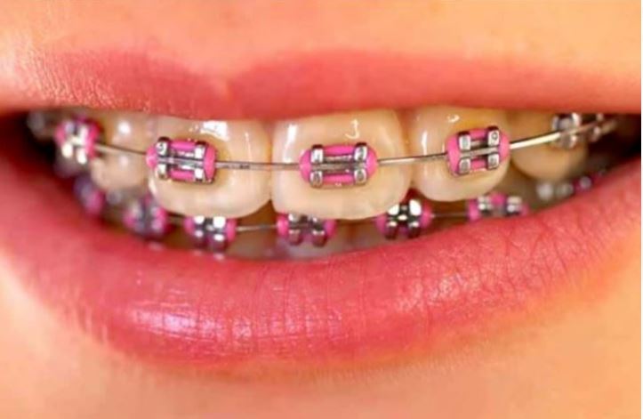 METAL BRACES