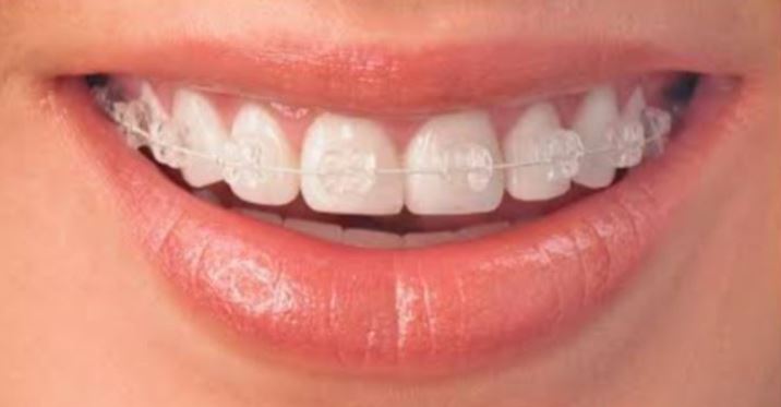 CERAMIC BRACES