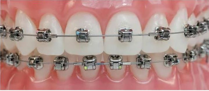 SELF LIGATING BRACES