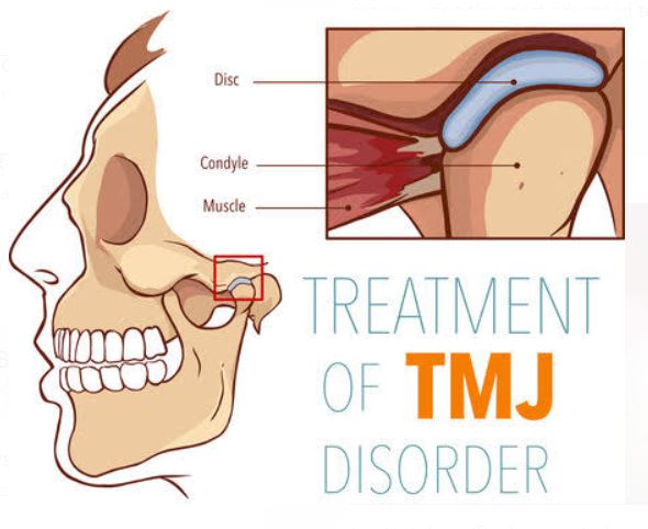 TMJ DISORDERS